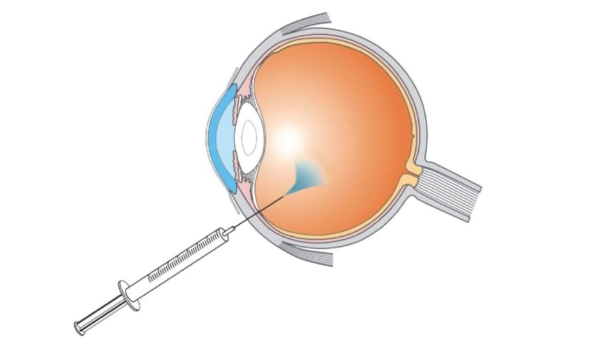 Phương pháp tiêm nội nhãn là kỹ thuật bơm thuốc trực tiếp vào mắt để điều trị
