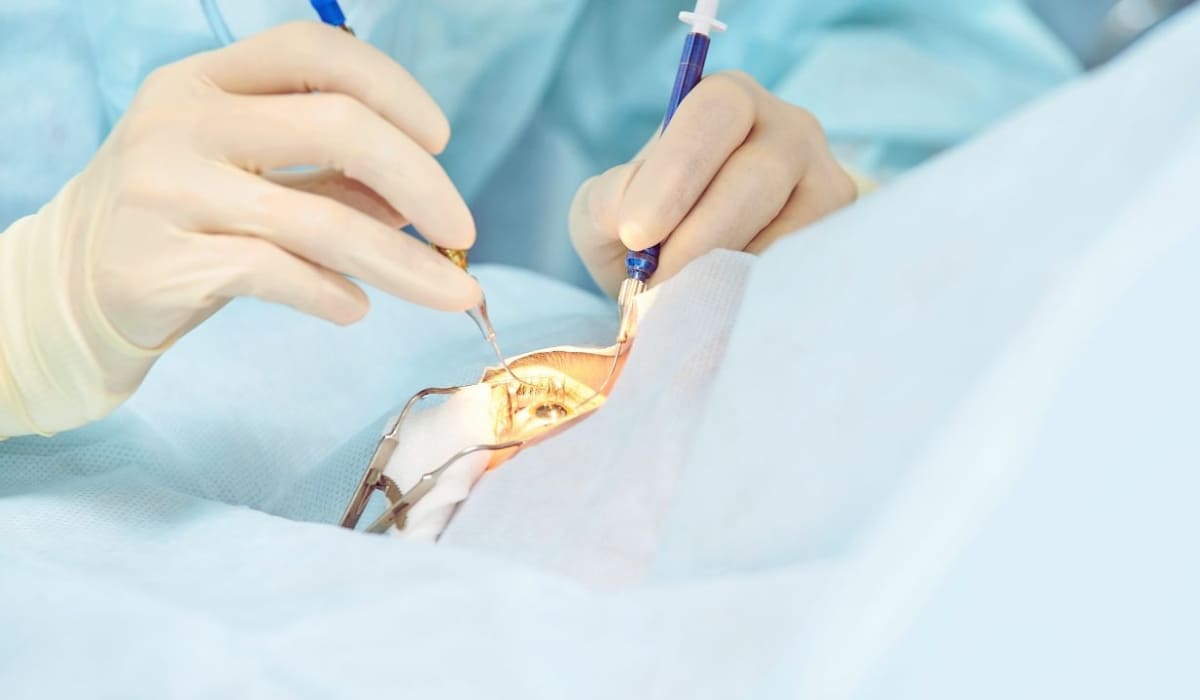 Quá trình thực hiện tạo hình thẩm mỹ mắt