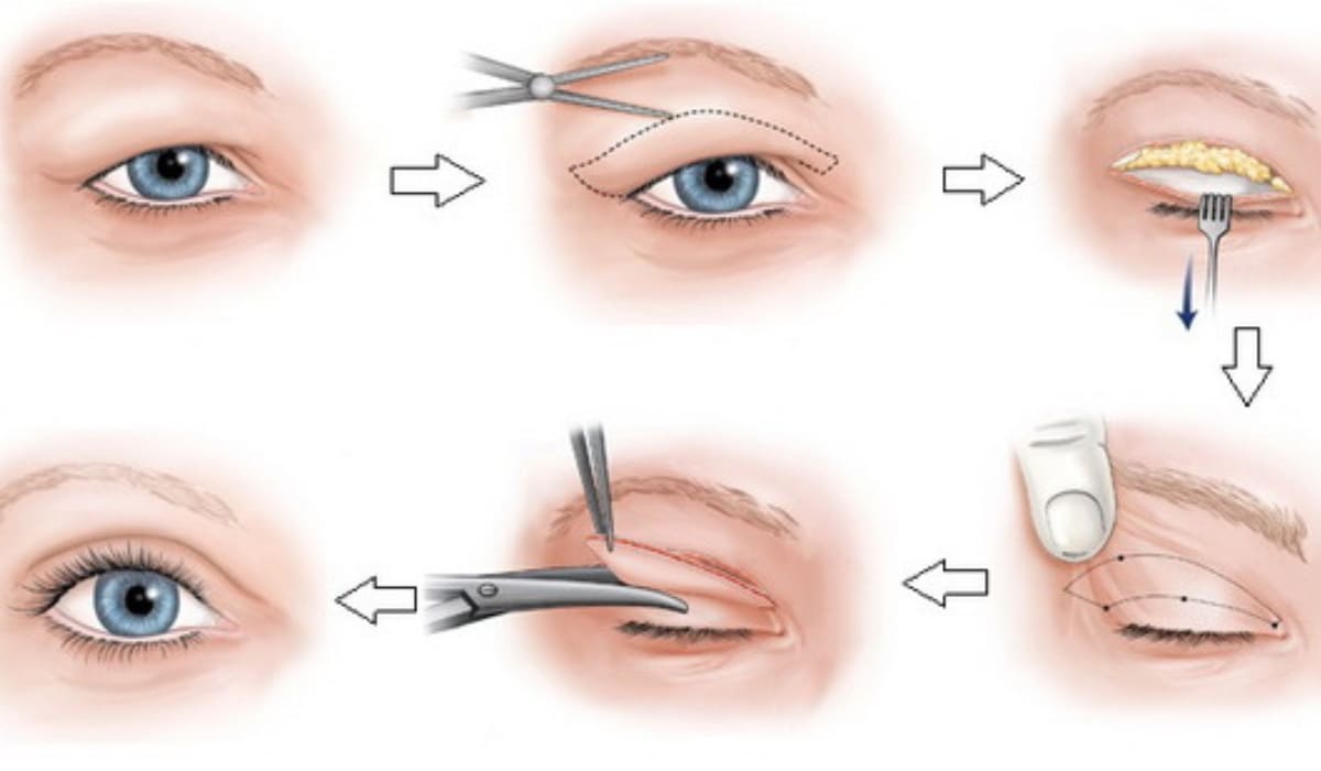 Quy trình thực hiện phẫu thuật cắt da thừa mí