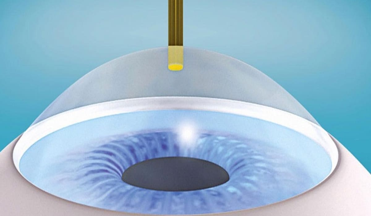 SmartSurfACE: không chạm, không tạo vạt, hồi phục nhanh và giảm biến chứng