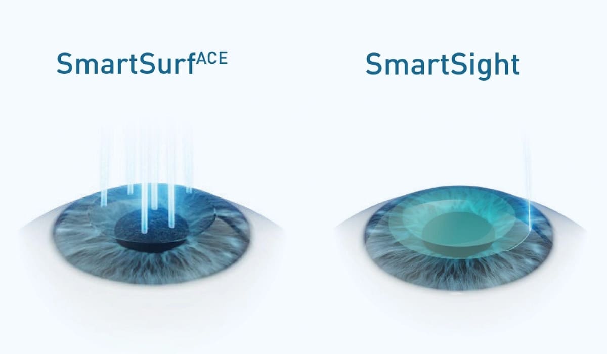 SmartSurfACE: laser Excimer bóc tách biểu mô, tái định hình giác mạc và tái tạo biểu mô không cần tạo vạt