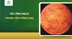 tắc tĩnh mạch trung tâm võng mạc