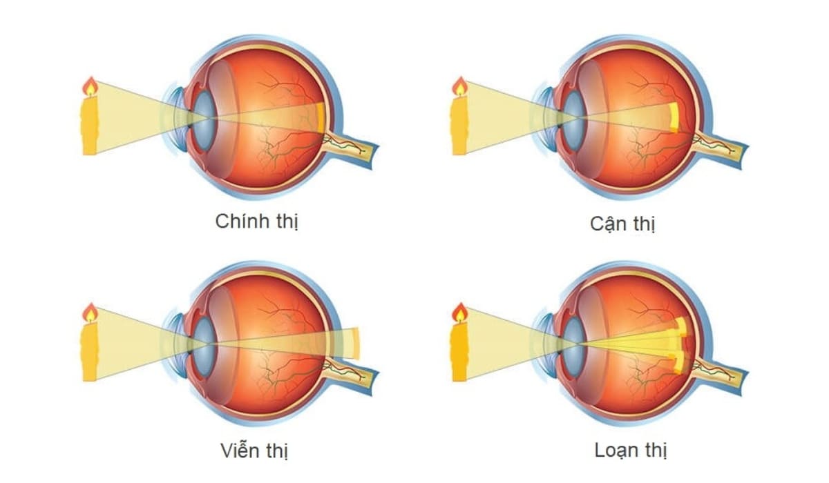 Tật khúc xạ là ánh sáng không hội tụ đúng trên võng mạc, gây mờ hoặc méo hình ảnh
