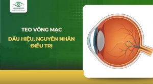 teo võng mạc