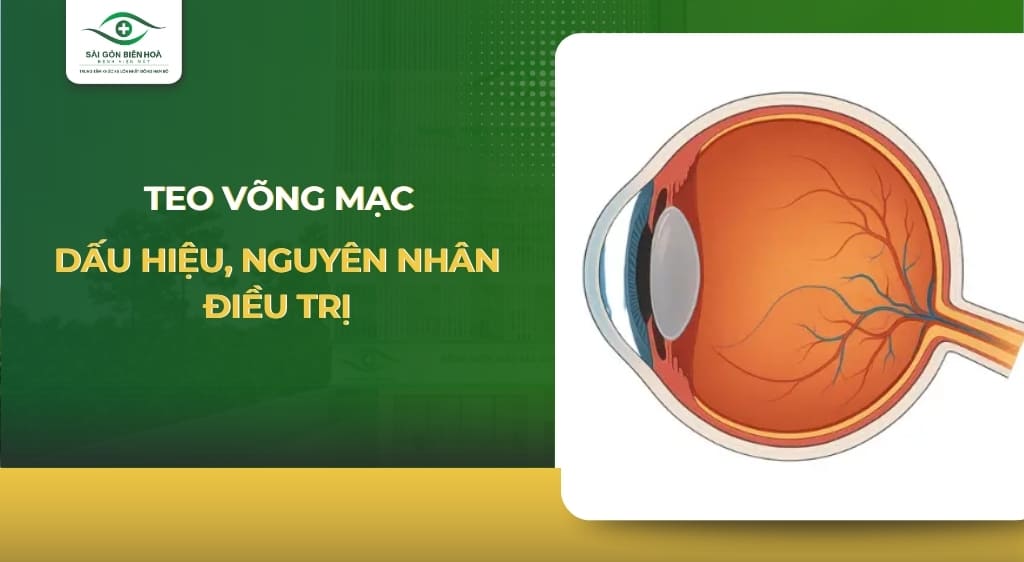 teo võng mạc