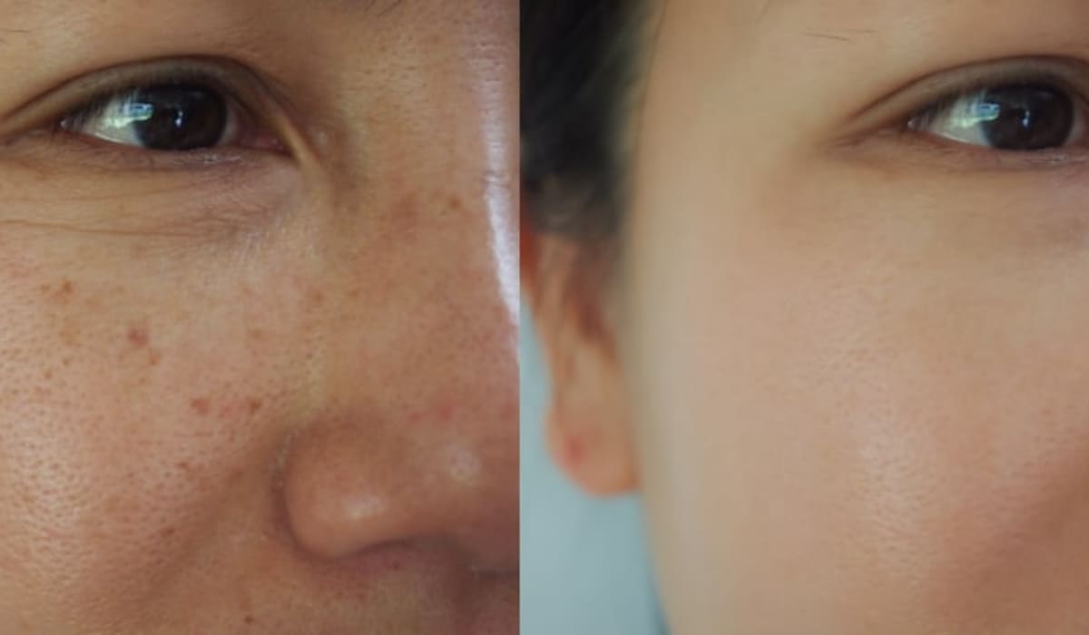 Tiêm xóa nhăn vùng quanh mắt giúp làn da trong mịn màng hơn