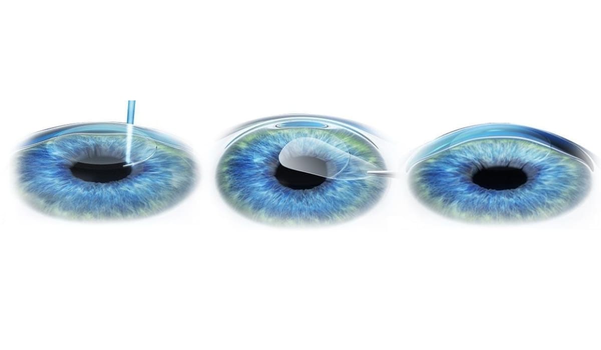 Trong phẫu thuật Femtosecond LASIK Pro tạo vạt giác mạc mịn và chính xác hơn