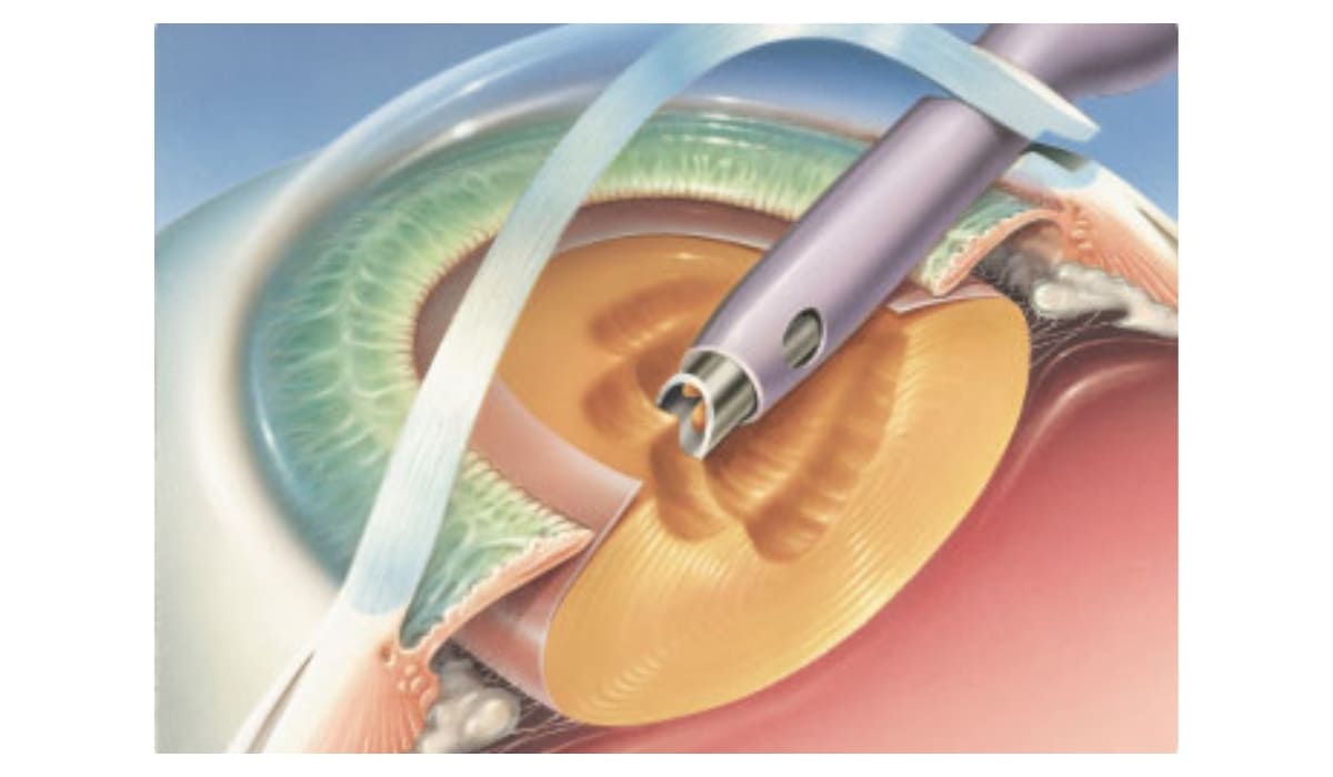 Trong phẫu thuật Phaco, bác sĩ tạo một đường rạch rất nhỏ rồi sử dụng năng lượng siêu âm để tán nhuyễn và hút bỏ thủy tinh thể bị đục.