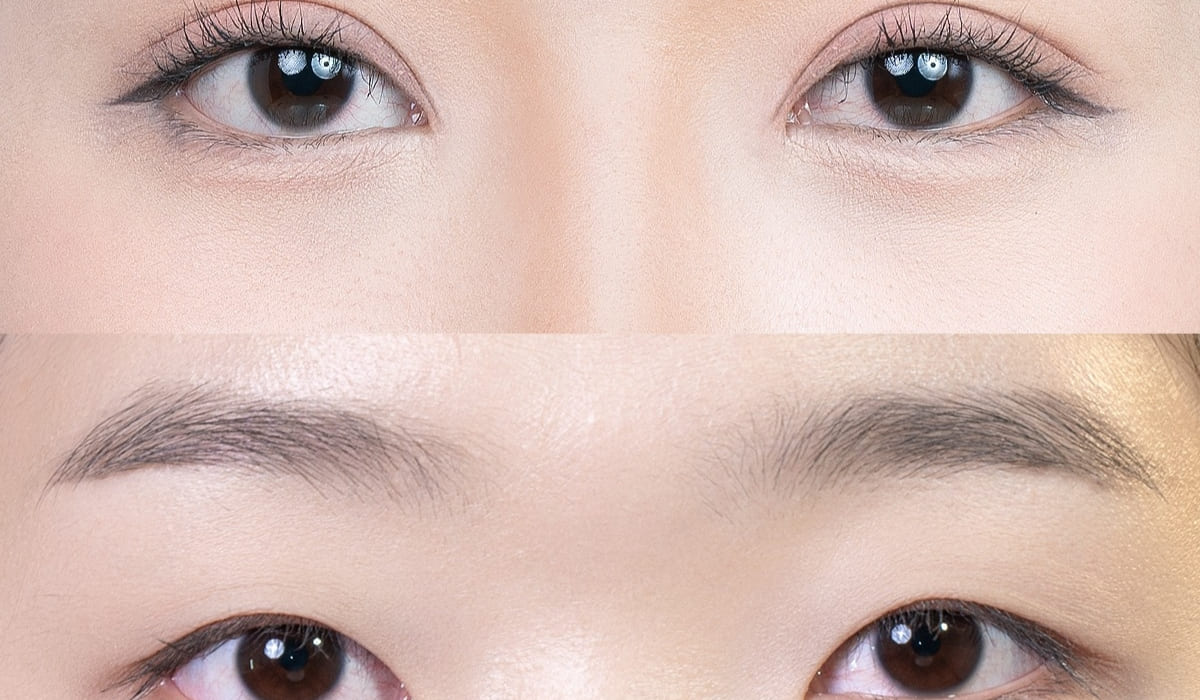 Trước và sau khi thực hiện tạo hình thẩm mỹ mắt giúp khuôn mặt hài hòa, tươi tắn hơn.