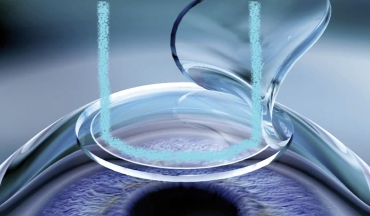 Ưu điểm Femto Pro: chính xác, đa dạng tật khúc xạ, hồi phục nhanh