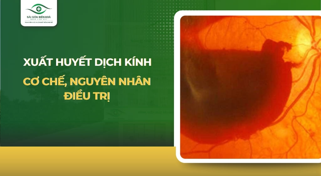 xuất huyết dịch kính