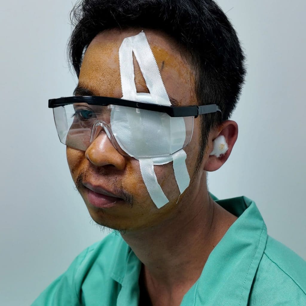 Anh Phạm Văn Chiều miếng Bazơ sắt bay vào mắt trong lúc làm việc