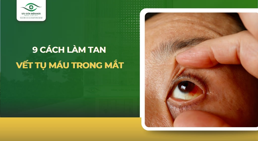 cách làm tan vết tụ máu trong mắt