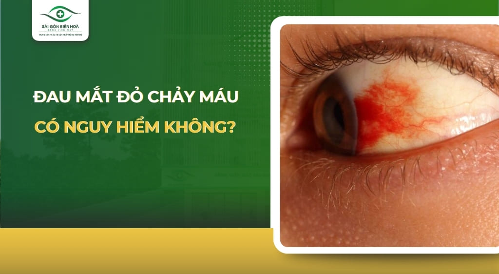 đau mắt đỏ chảy máu