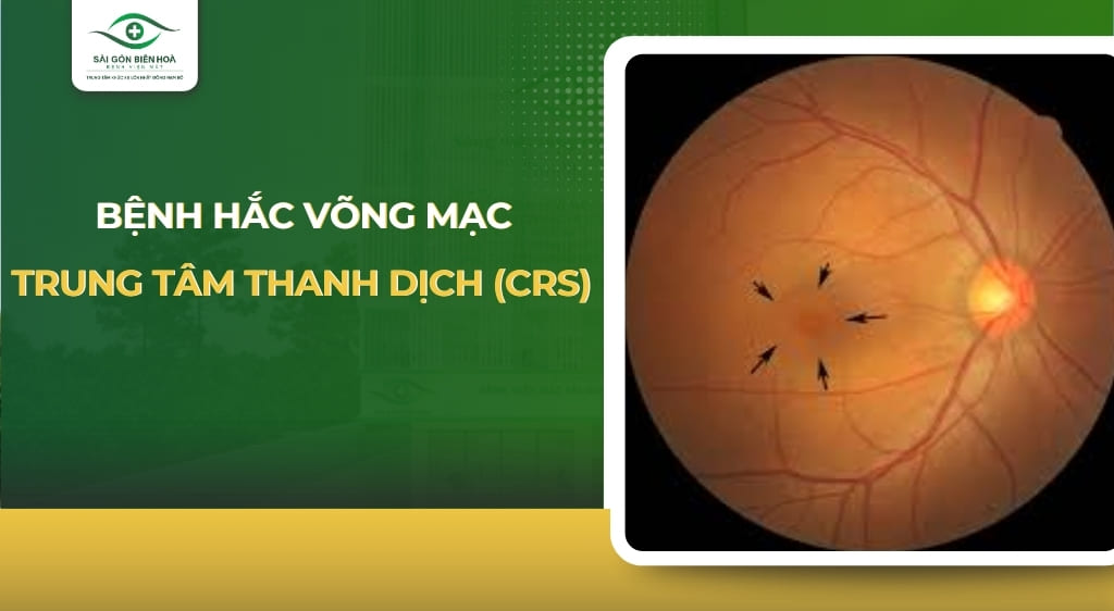 hắc võng mạc trung tâm thanh dịch