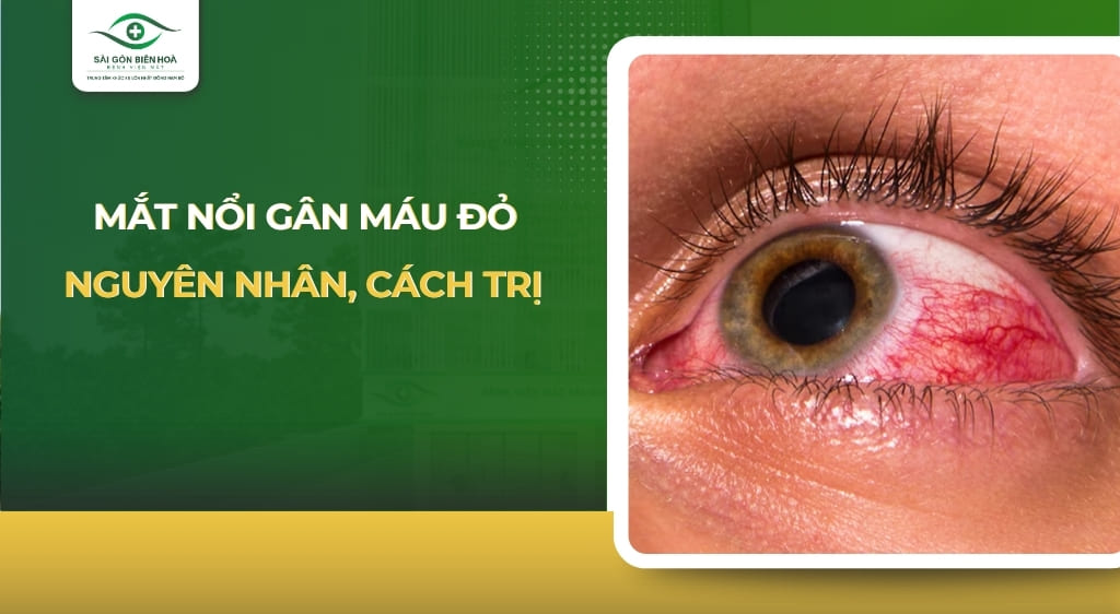 mắt nổi gân máu đỏ