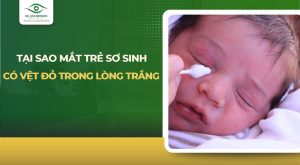 mắt trẻ sơ sinh có vệt đỏ