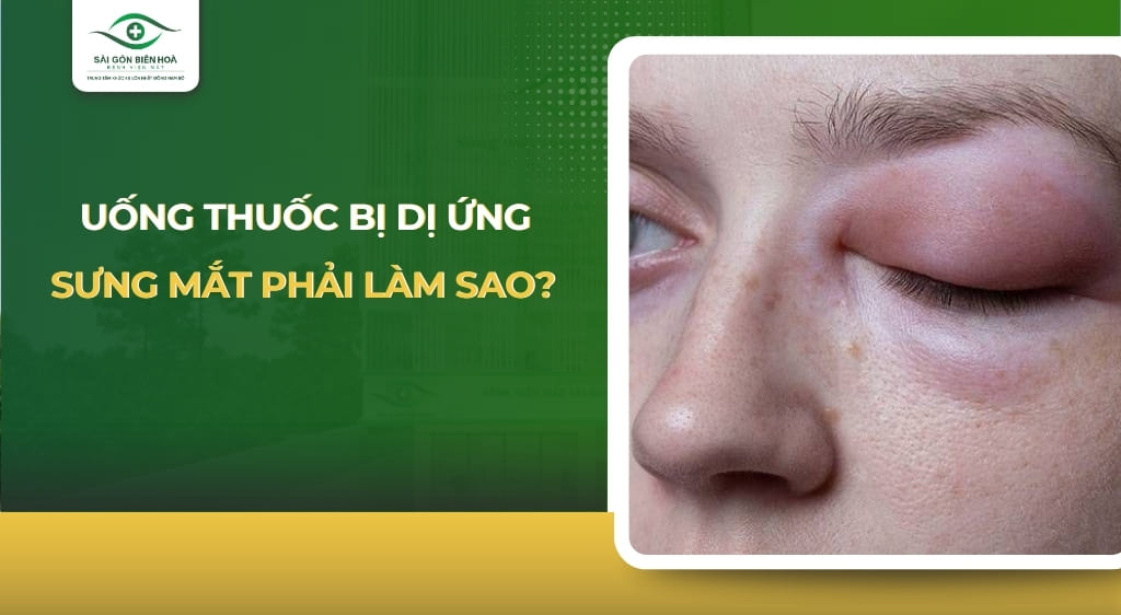 Uống thuốc bị dị ứng sưng mắt phải làm sao