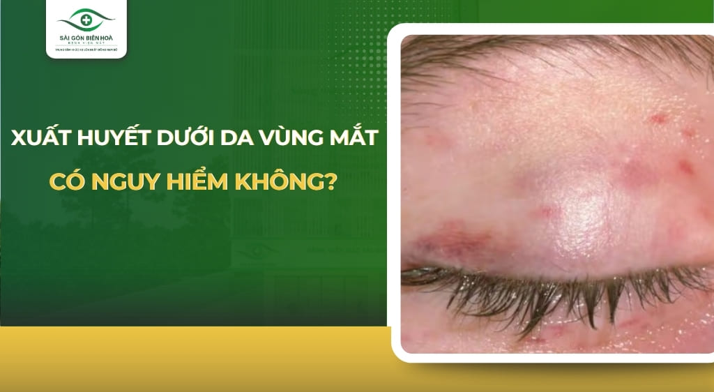 xuất huyết dưới da vùng mắt
