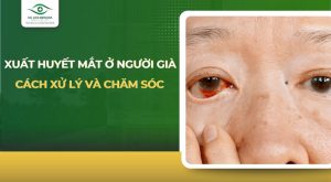 xuất huyết mắt ở người già