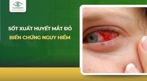 Sốt xuất huyết mắt đỏ