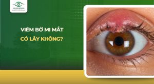 viêm bờ mi mắt có lây không