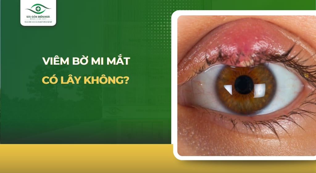 viêm bờ mi mắt có lây không
