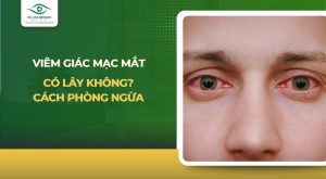 viêm giác mạc mắt có lây không