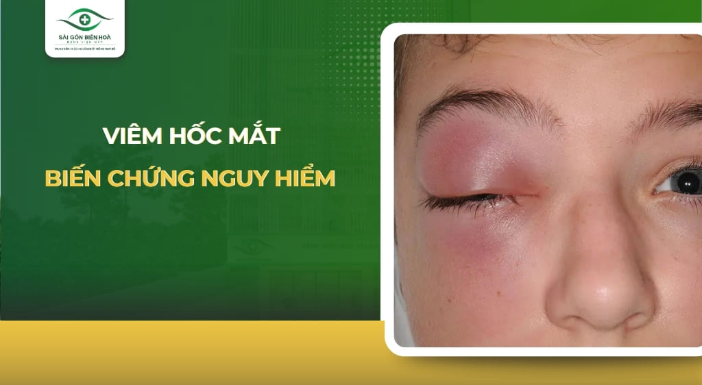viêm hốc mắt
