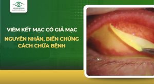 viêm kết mạc có giả mạc