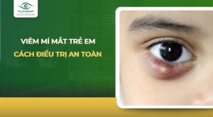viêm mí mắt trẻ em