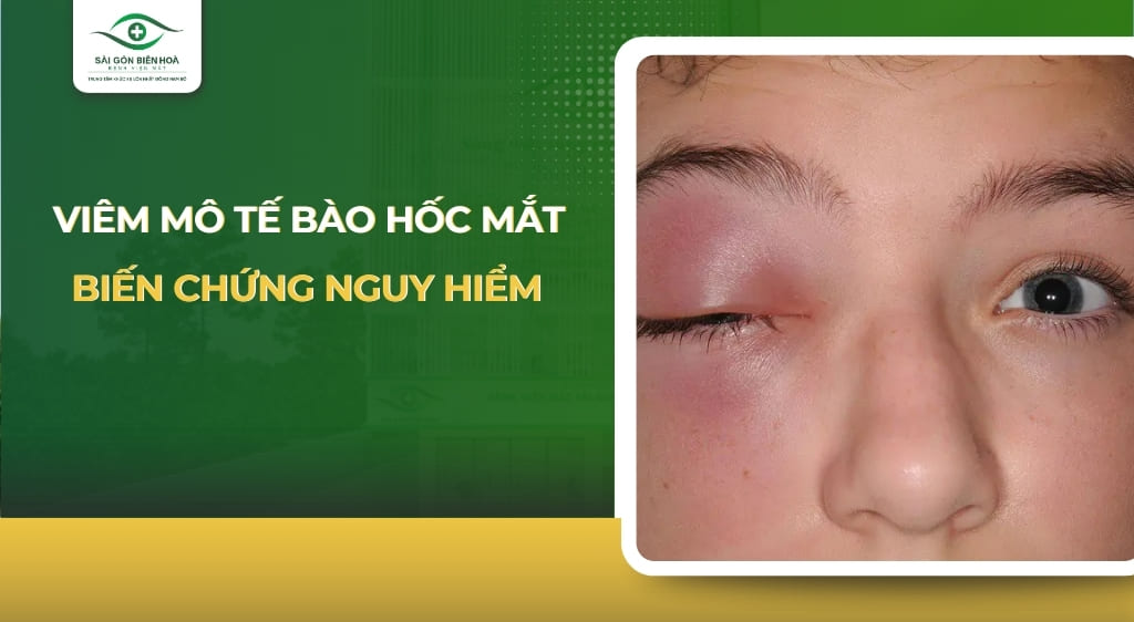 viêm mô tế bào hốc mắt