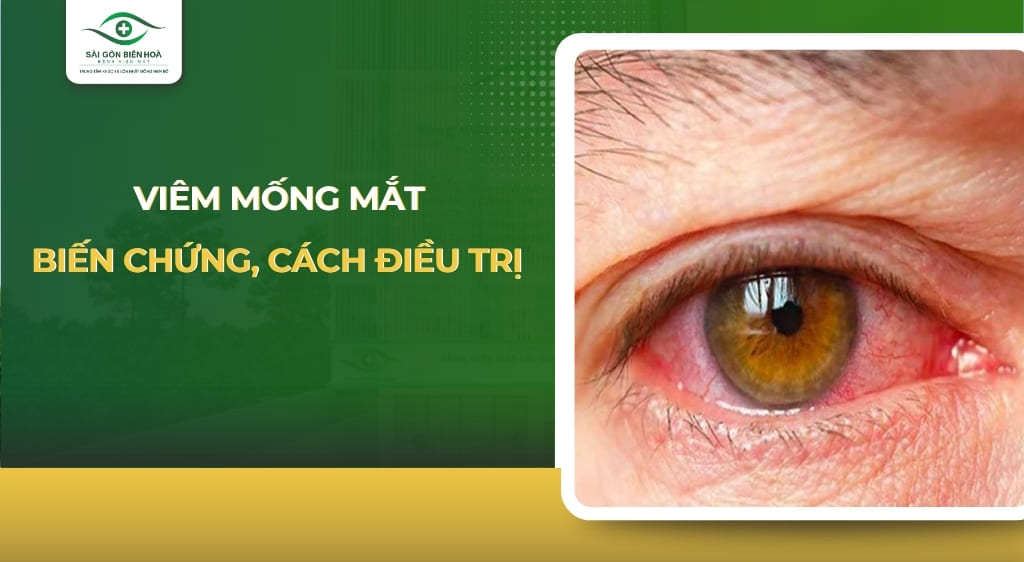 viêm mống mắt