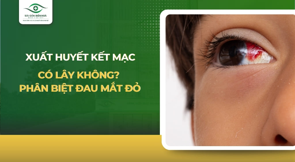 xuất huyết kết mạc có lây không