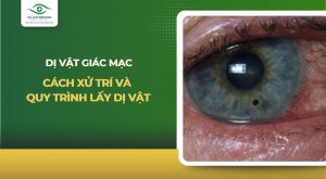 dị vật giác mạc