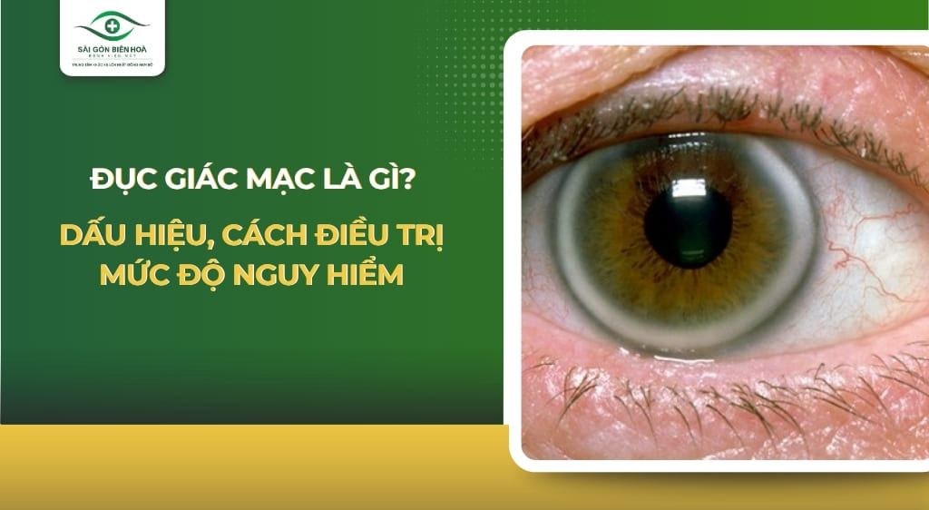đục giác mạc