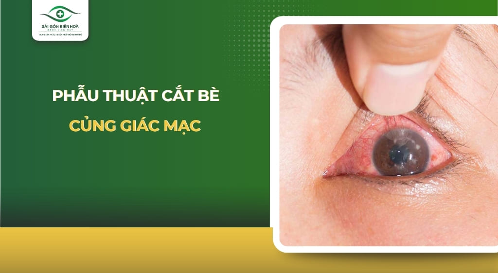 phẫu thuật cắt bè củng giác mạc