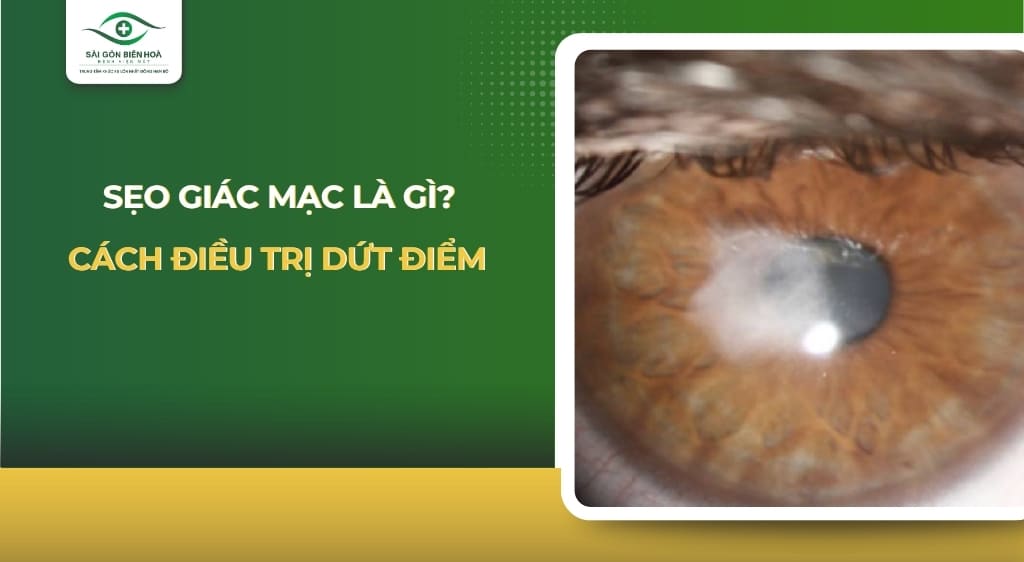 sẹo giác mạc