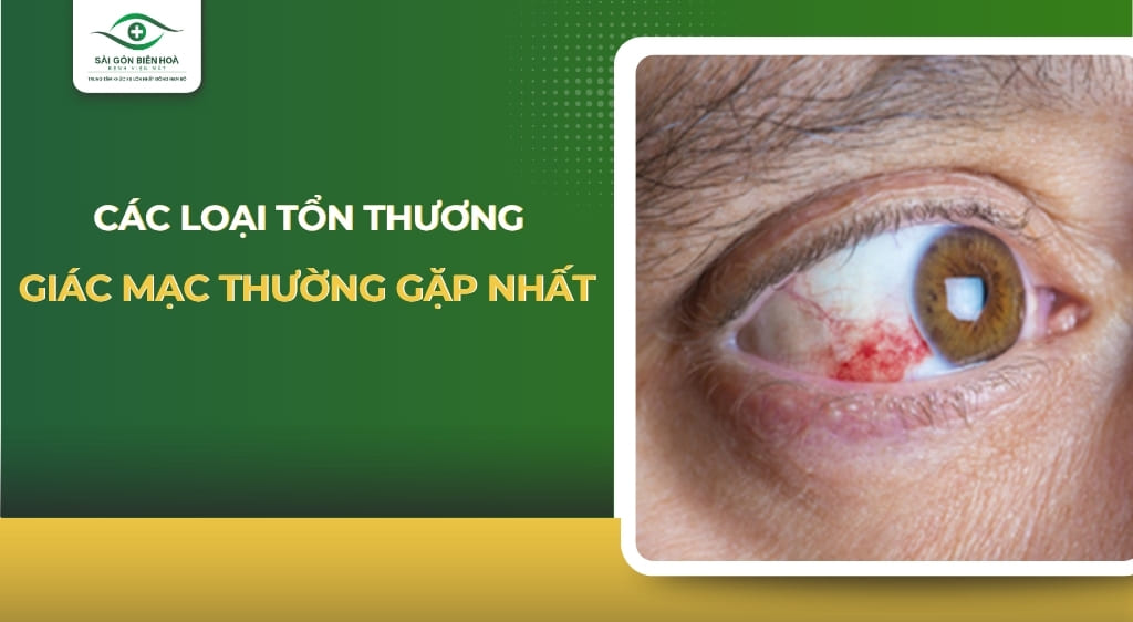 tổn thương giác mạc