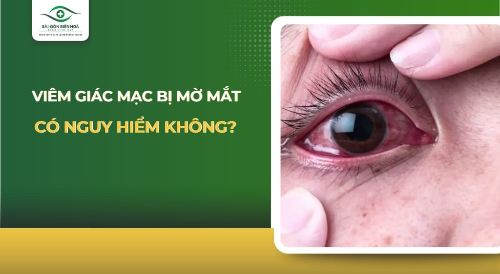 viêm giác mạc bị mờ mắt