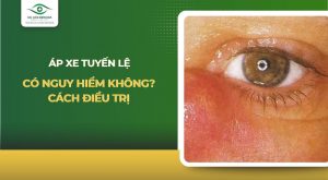 áp xe tuyến lệ