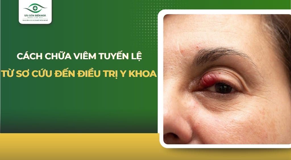 cách chữa viêm tuyến lệ