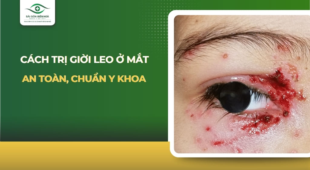 Cách trị giời leo ở mắt