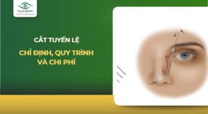 cắt tuyến lệ