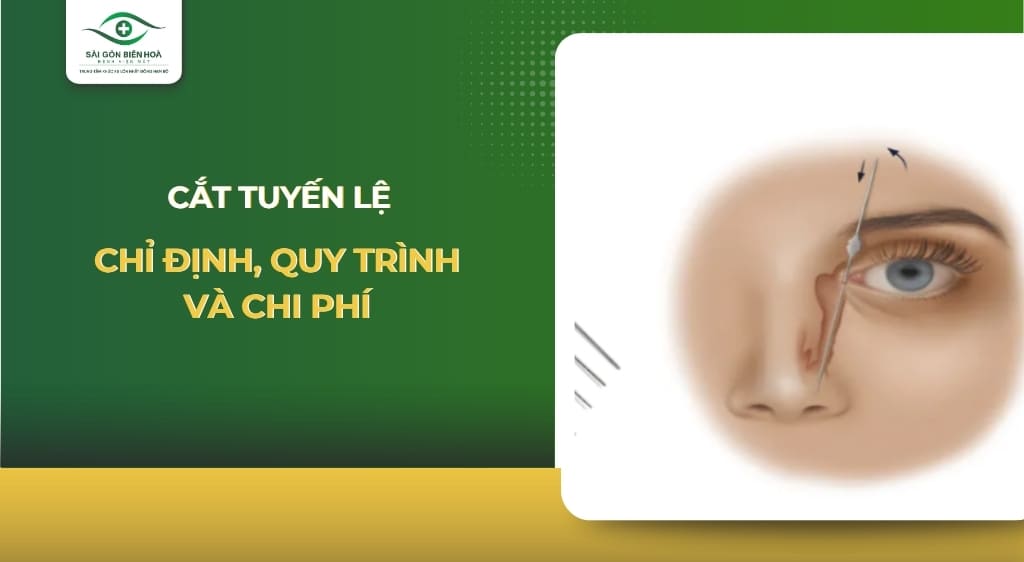 cắt tuyến lệ