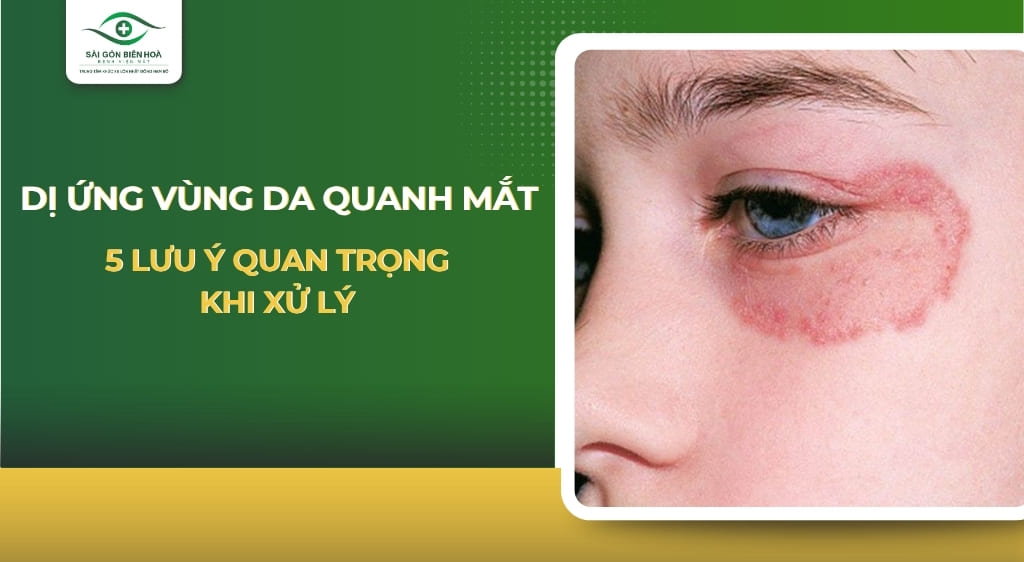 dị ứng vùng da quanh mắt