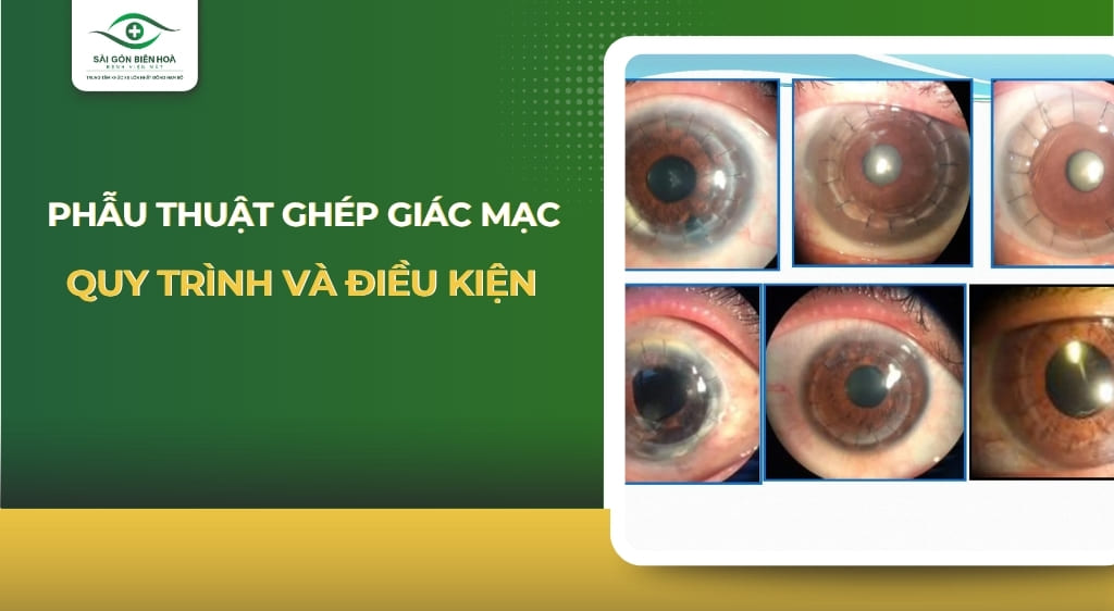 ghép giác mạc