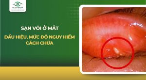 sạn vôi ở mắt