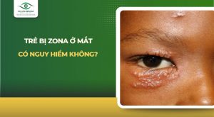 Trẻ bị zona ở mắt