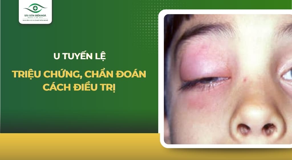 u tuyến lệ